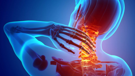 spondylosis treatment